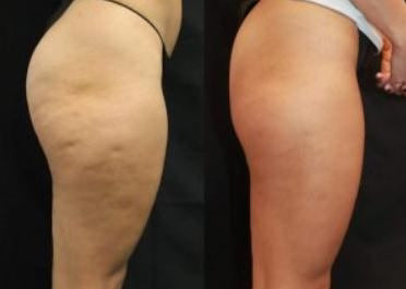 CelluFree 4D