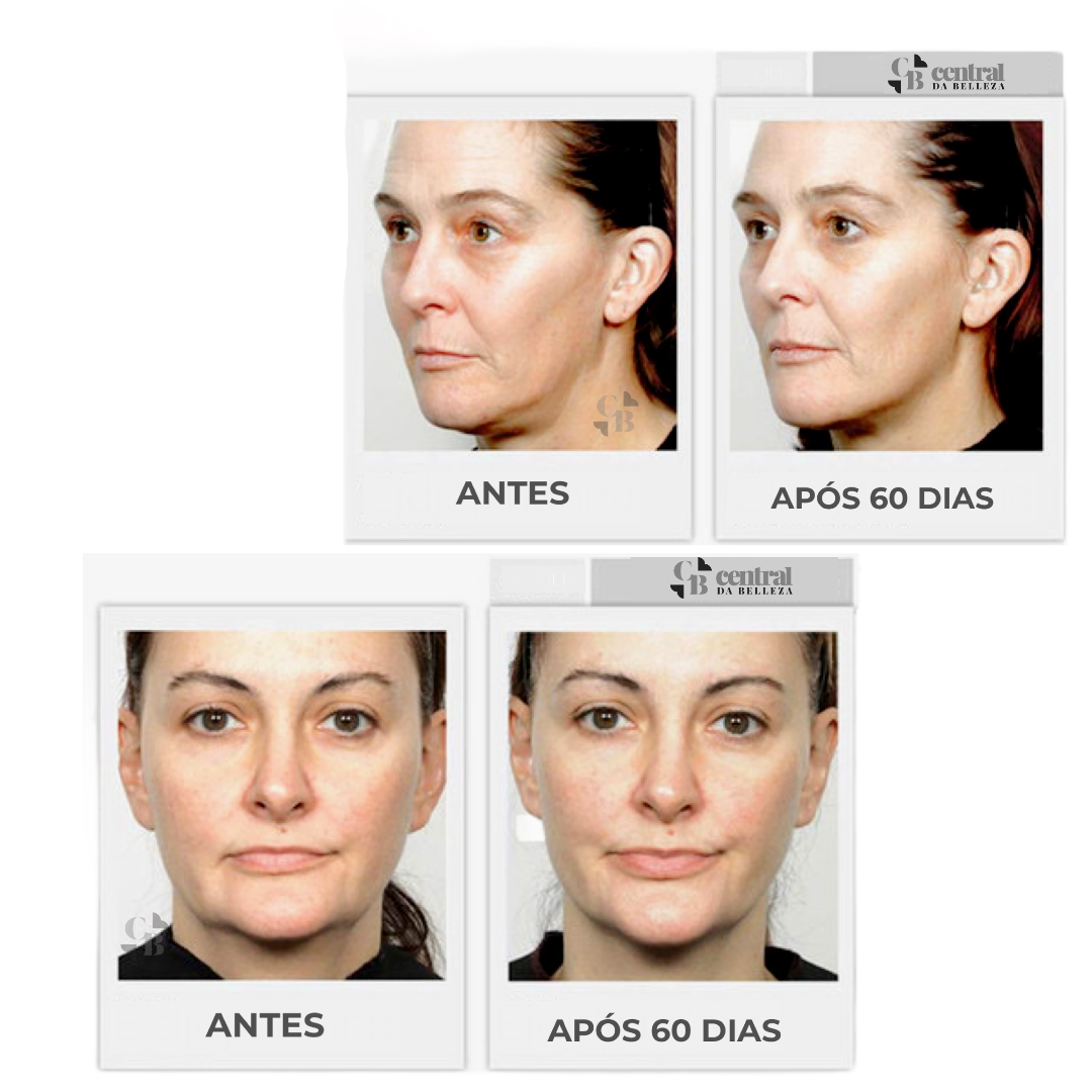 Massageador Facial de Microcorrente - FaceLift